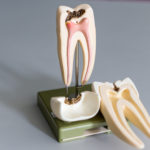 root canal model