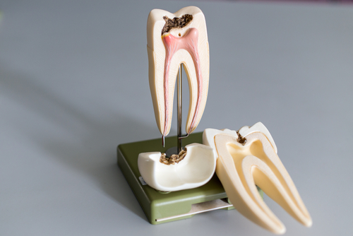 root canal model