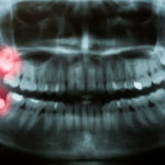 wisdom teeth on dental x-ray