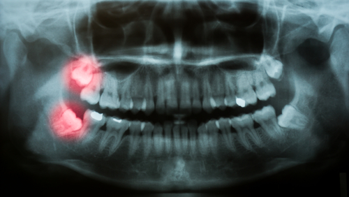 wisdom teeth on dental x-ray
